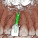 Arizona Smiles Dentistry - Implant Dentistry