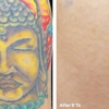 Laser Tattoo Removal by Tatt Cemetery gallery