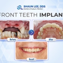 Shaun Lee DDS: Dental Implant and General Dentistry of Auburn - Dentists