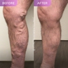 Vein Treatment Clinic | Sacramento gallery