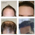 Natural Transplants, Hair Restoration Clinic