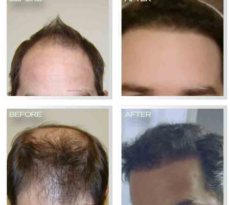 Natural Transplant, Hair Restoration Clinic MIAMI - Miami, FL