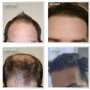 Natural Transplants, Hair Restoration Clinic