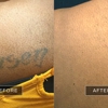 Removery Tattoo Removal & Fading gallery
