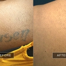 Removery Tattoo Removal & Fading - Tattoo Removal