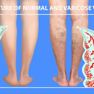Charming Skin & Vein Clinics - Orland Park, IL. Causes of Varicose veins
