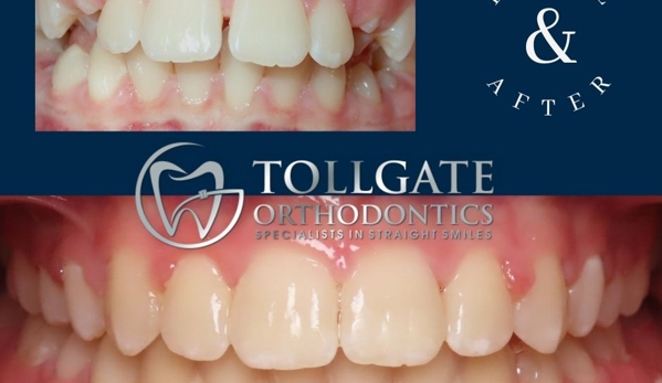 Tollgate Orthodontics - Warwick, RI. overbite smile before and after