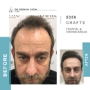 Hair Transplant Turkey | Dr. Serkan Aygin | Miami Branch Office - Hair Replacement