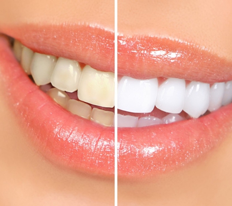 Natural White Advanced Teeth Whitening - Charlotte, NC