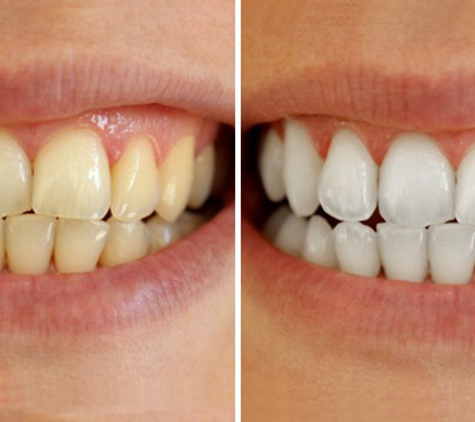 Maui Whitening South Tampa - Tampa, FL