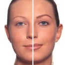 Tattoo - Tattoo Removal