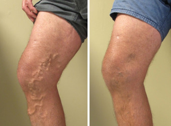 California Vein Specialists - Newport Beach, CA