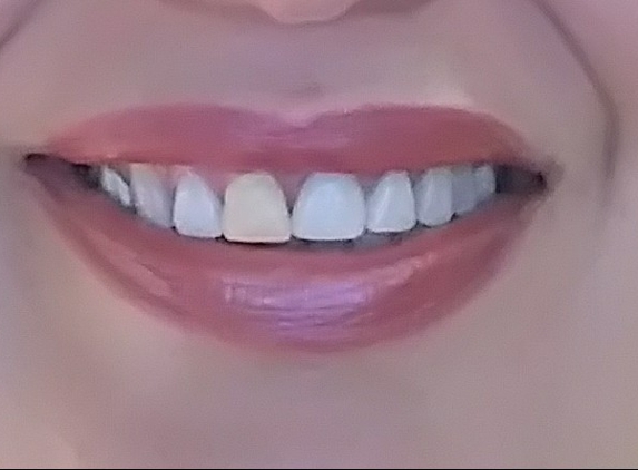 Southern Dental Associates - Houston, TX. was not able to fit in middle crowns. middle crown is placed at an angle. she (purposely I am sure) made this temporary yellow crown for me.