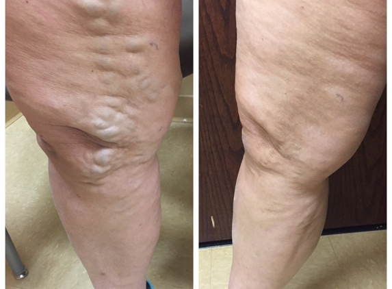 Consultants In Cardiology-Electrophysiology-Cce Vein-VSCLR - Oak Lawn, IL. Before and after varicose vein ablation and phlebectomy