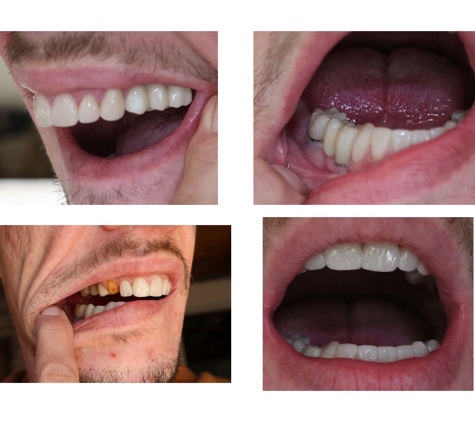 Nellmar Laboratory Inc - Saline, MI. Had a full mouth restoration through this lab and My dentist said they were using the wrong model.. It looks like they used the wrong model.