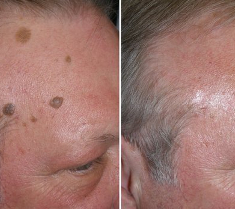 Liberty Family Physicians - Matthews, NC. Yes, we do that!  Our office removes warts, moles and cysts and makes you look beautiful again!  Call us at 704-844-0505 today!