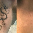 TakeTatt Tattoo Removal - Tattoo Removal