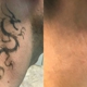 TakeTatt Tattoo Removal