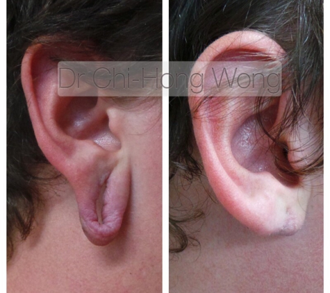 Cosmetic Laser & Skin Cancer Centre - Brendale, QLD. Before and After Earlobe Repairs from Stretchers Torn earlobes