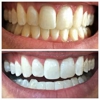 Glintr Mobile Teeth Whitening gallery