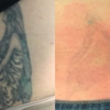 TakeTatt Tattoo Removal gallery