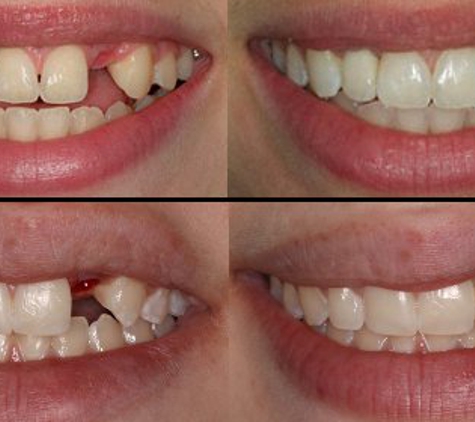 Miracle Smile Dentistry - Coral Gables, FL. Dental Implants before and after www.miracle-smile.com  305-569-9966