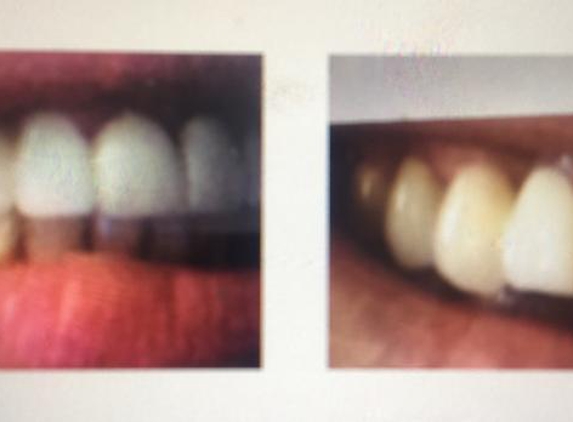 Hawthorn Road Family Dental Clinic - Caulfield North, VIC. Pic1- Before and Pic2- after Dr. Mahima