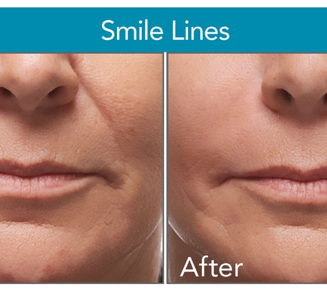 Charming Skin & Vein Clinics - Orland Park, IL. Facial fillers