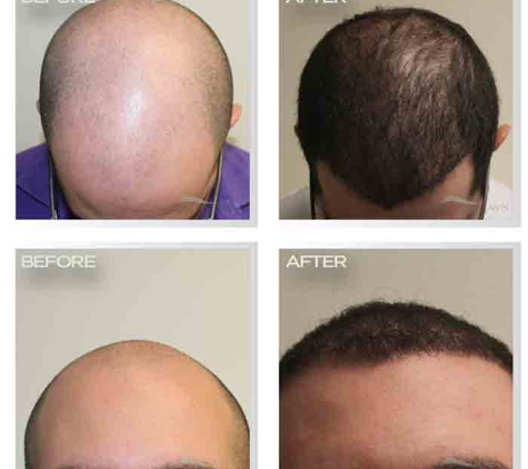 Natural Transplant, Hair Restoration Clinic MIAMI - Miami, FL