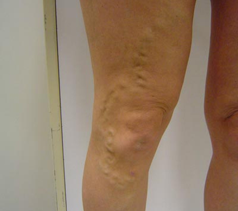 Vein Health Medical Clinic - Melbourne, VIC. Varicose Veins Specialist Melbourne