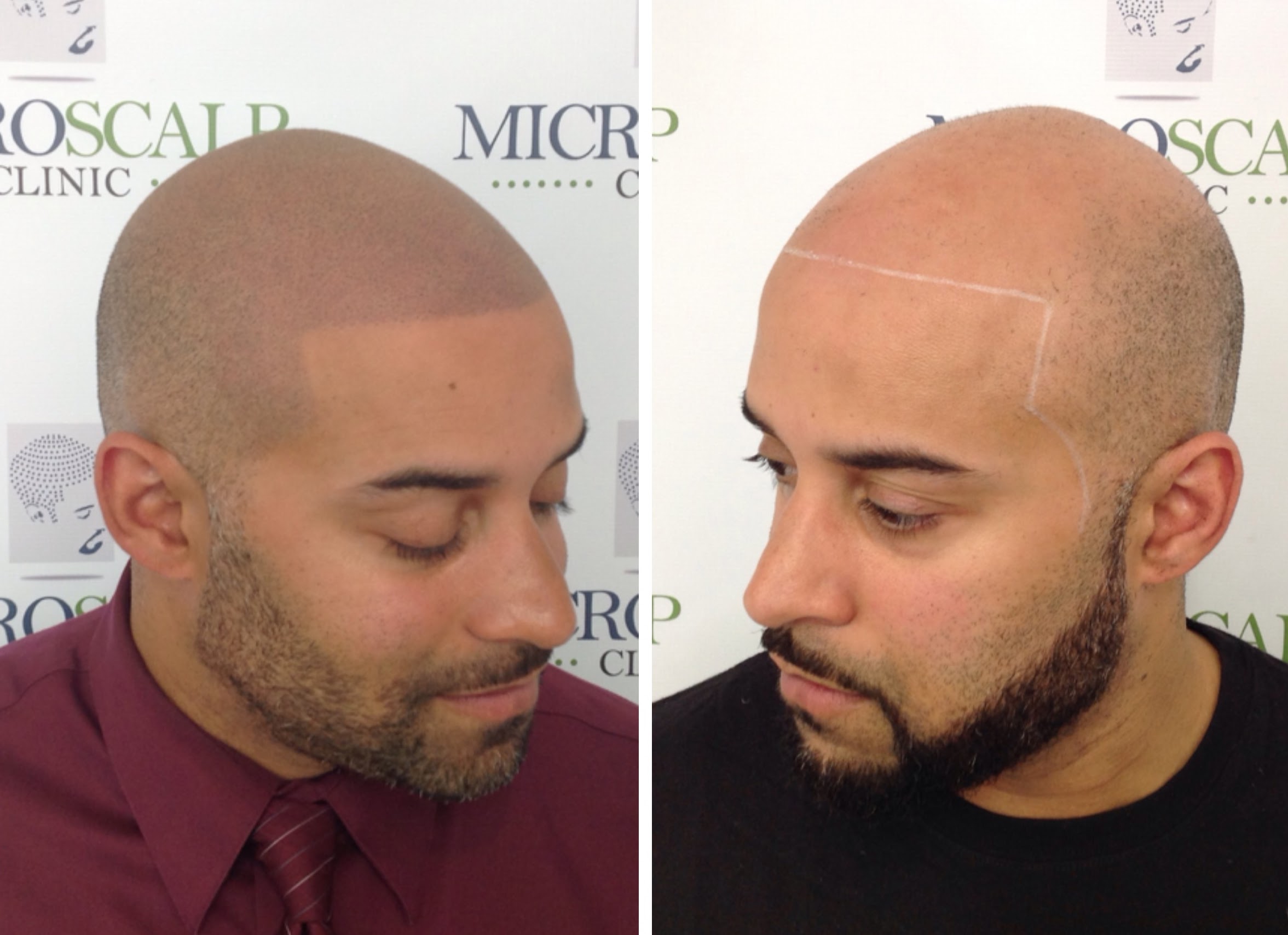 Fonkelnieuw Micro Scalp Clinic 176 Newbury St, Boston, MA 02116 - YP.com VH-04