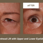 Klapper Eyelid & Facial