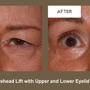 Klapper Eyelid & Facial