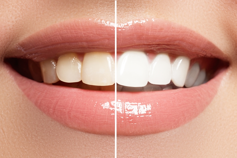Cosmetic dentistry can be used to simply whiten teeth, or give a whole smile makeover.