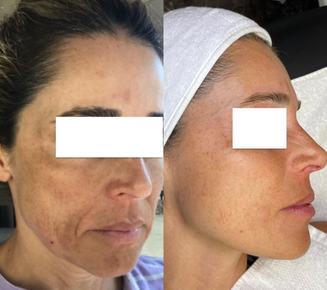 Crystal Skin Care - Kaysville, UT. Microdermabrasion: Before and After