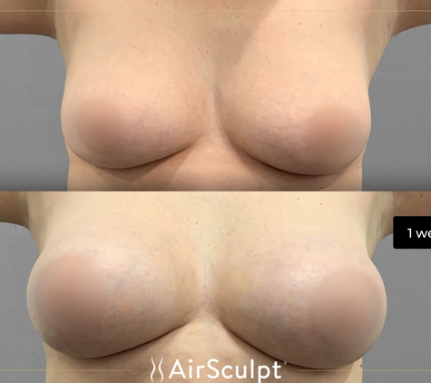 AirSculpt - Denver - Denver, CO