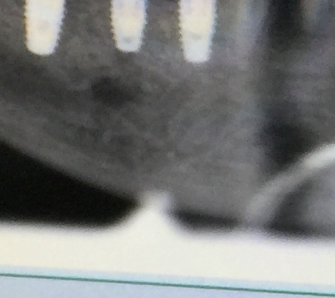 Dominick Catania - Tampa, FL. 3 implants, bone graft, the dark spot is the nerve