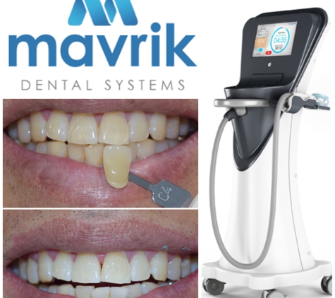 Pierce Aesthetics - Tustin, CA. Mavrik Teeth Whitening System  -  Before & After