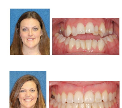Stone Creek Orthodontics - San Antonio, TX. Before and After 
Dr. Megna's Patient