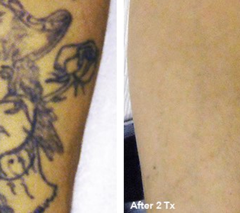 Eraser Clinic Laser Tattoo Removal - San Antonio, TX