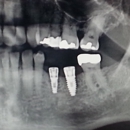 Dental Implant Services - Implant Dentistry