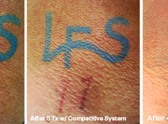 Laser Tattoo Removal by Tatt Cemetery - Fort Myers, FL