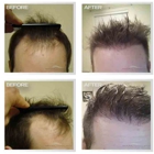 Natural Transplant, Hair Restoration Clinic MIAMI