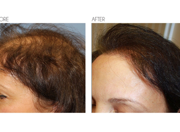 Beverly Hills Hair Restoration - Beverly Hills, CA