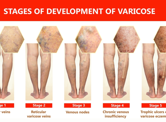 Dr. Jawdat J Abboud, MD - Palos Hills, IL. Varicose veins stages