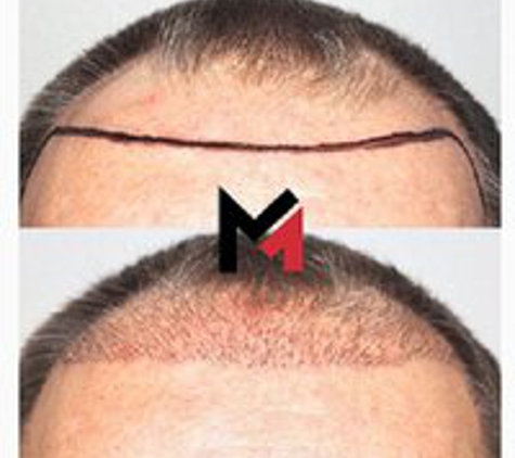 MAXIM Hair Restoration - Sarasota, FL