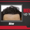 MAXIM Hair Restoration gallery