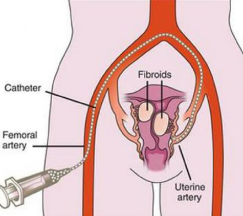 USA Fibroid Centers - Washington, DC