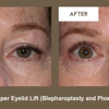 Klapper Eyelid & Facial gallery