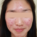 Proderma Acne Clinic - Skin Care